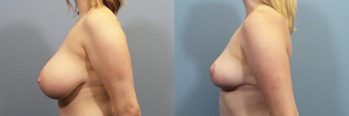 Before & After Breast Reduction Case 122 View #3 View in Portland, OR