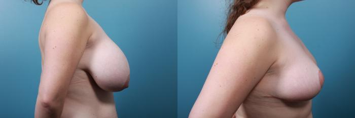 Before & After Breast Reduction Case 234 View #2 View in Portland, OR