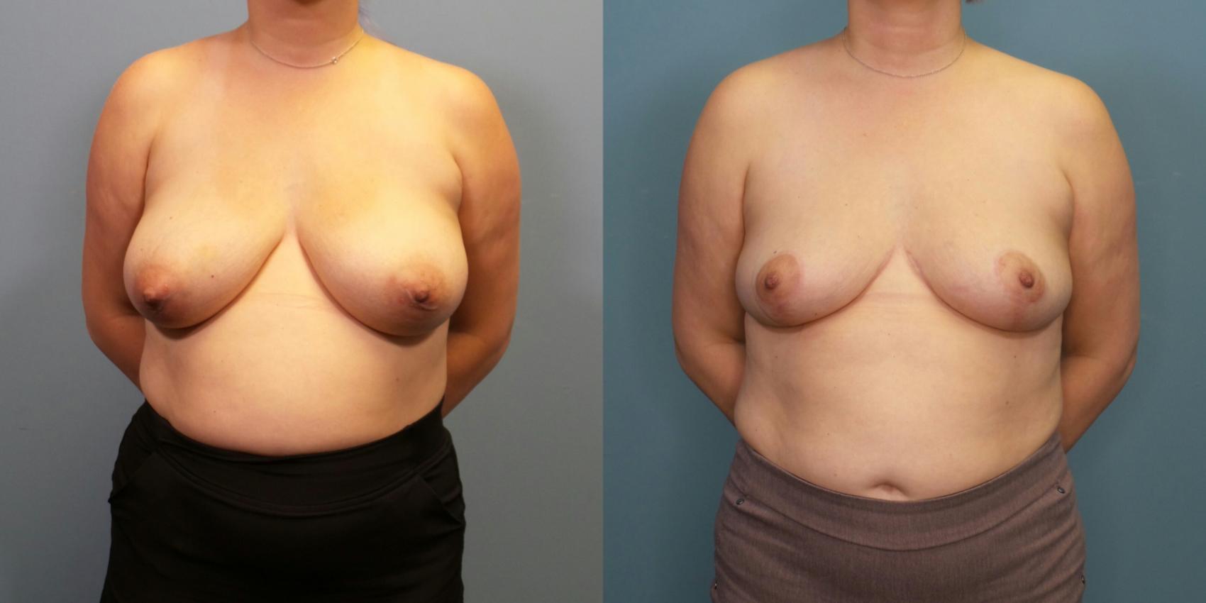 Before & After Breast Reduction Case 274 Front View in Portland, OR