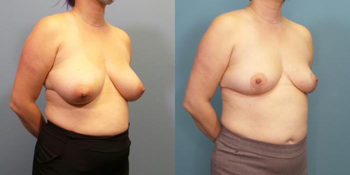 Before & After Breast Reduction Case 274 Right Oblique View in Portland, OR