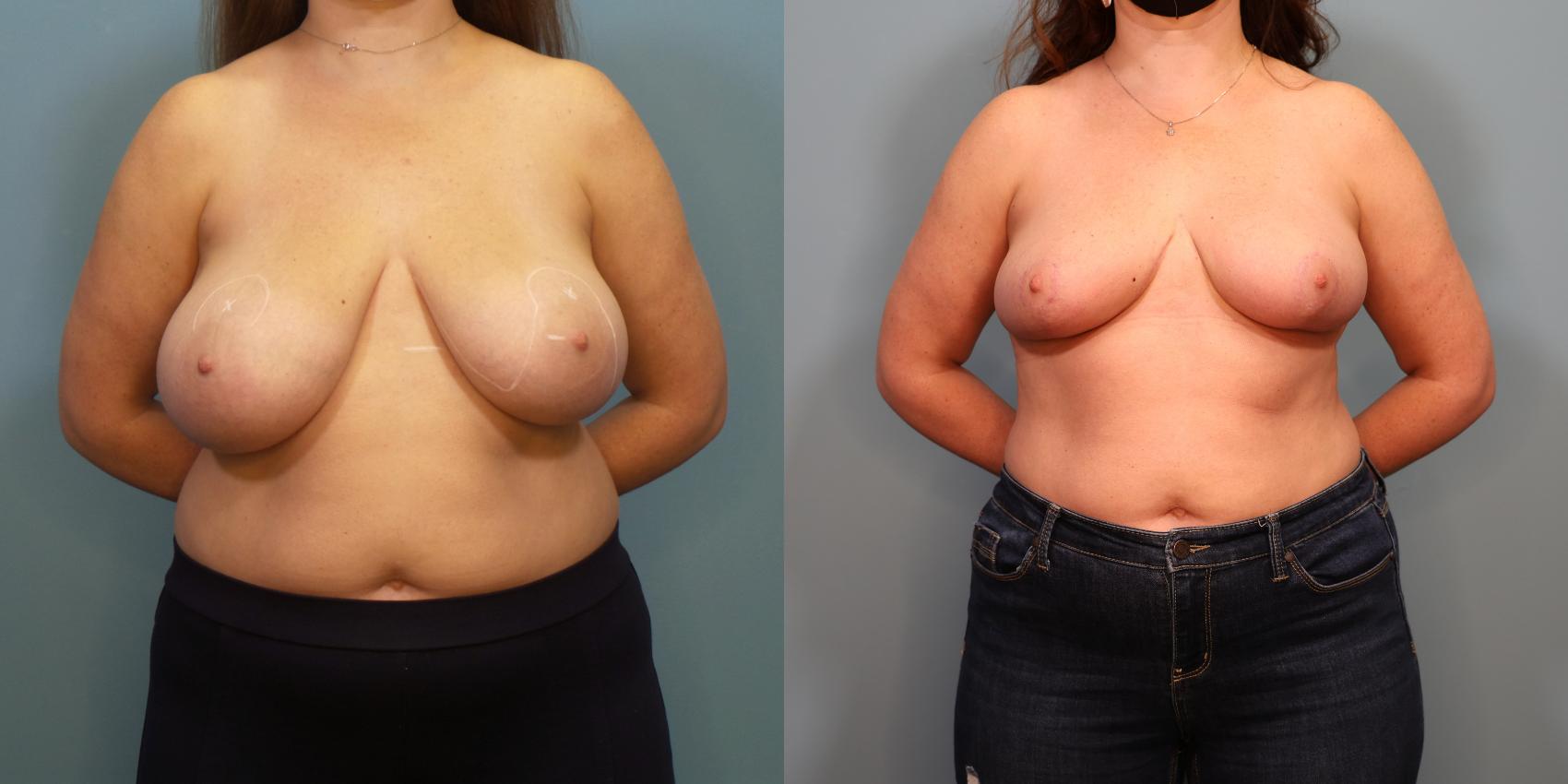 Before & After Breast Reduction Case 294 Front View in Portland, OR