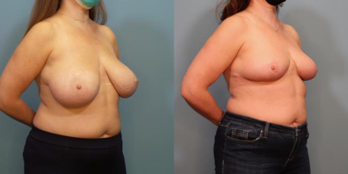Before & After Breast Reduction Case 294 Right Oblique View in Portland, OR