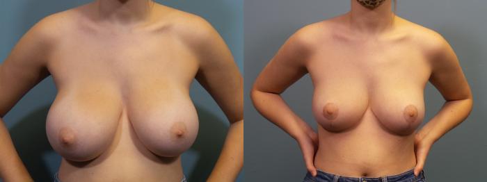 Before & After Breast Reduction Case 305 Front View in Portland, OR