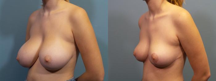Before & After Breast Reduction Case 305 Left Oblique View in Portland, OR