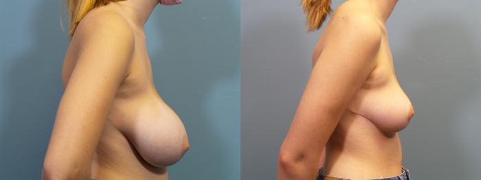 Before & After Breast Reduction Case 305 Right Side View in Portland, OR
