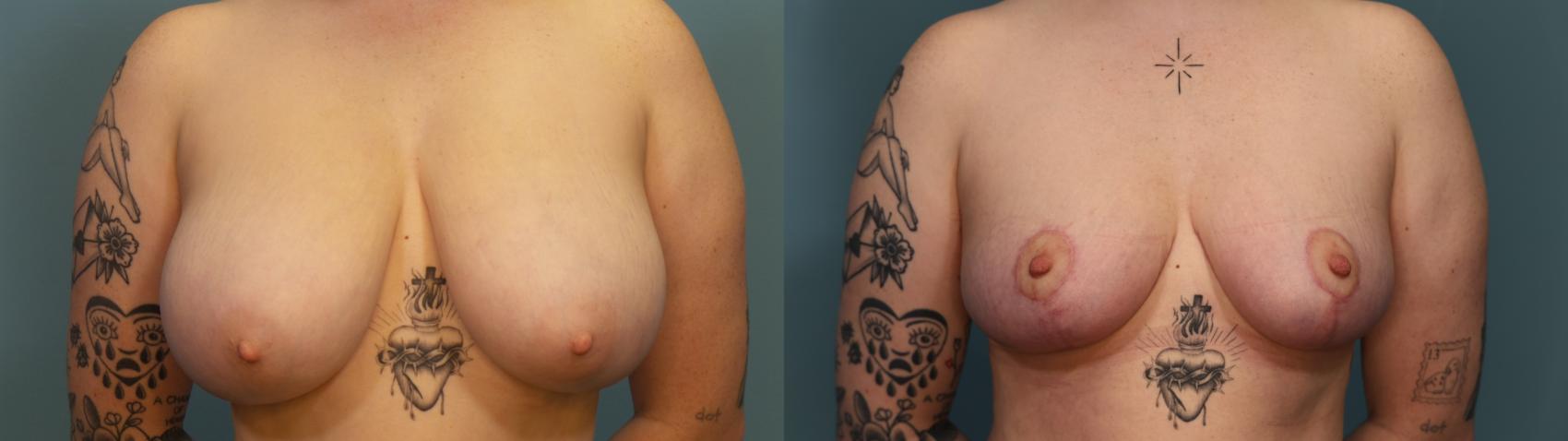 Breast reduction done by Dr. Kyle Baltrusch 
