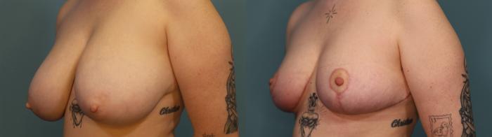 Before & After Breast Reduction Case 306 Left Oblique View in Portland, OR