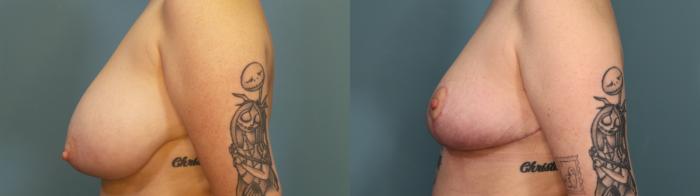 Before & After Breast Reduction Case 306 Left Side View in Portland, OR