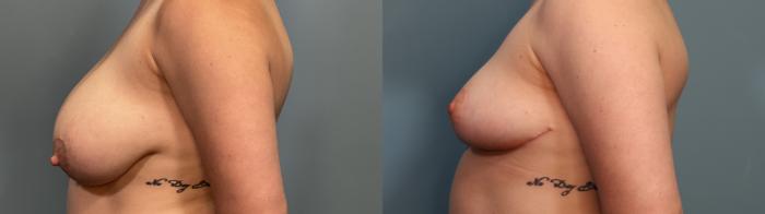Before & After Breast Reduction Case 309 Left Side View in Portland, OR