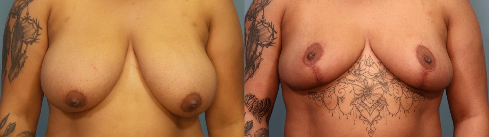 Before & After Breast Reduction Case 310 Front View in Portland, OR