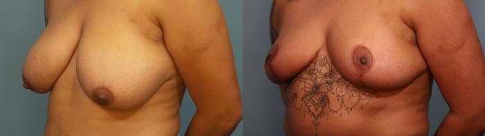 Before & After Breast Reduction Case 310 Left Oblique View in Portland, OR