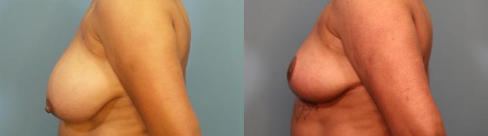 Before & After Breast Reduction Case 310 Left Side View in Portland, OR