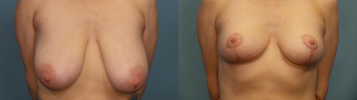 Before & After Breast Reduction Case 315 Front View in Portland, OR