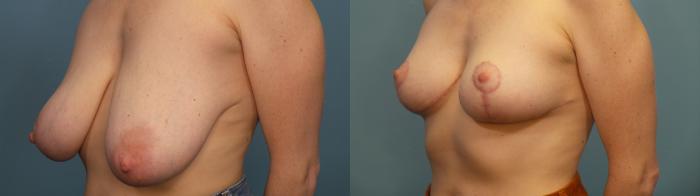 Before & After Breast Reduction Case 315 Left Oblique View in Portland, OR