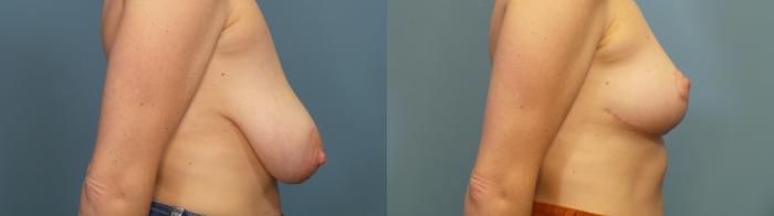Before & After Breast Reduction Case 315 Right Side View in Portland, OR
