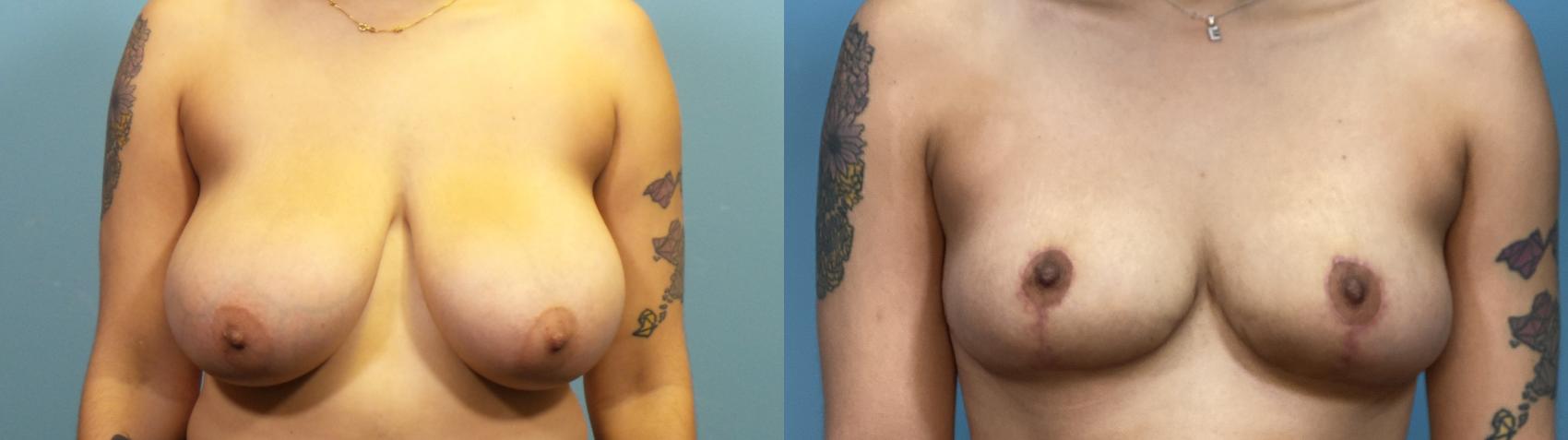 Before & After Breast Reduction Case 319 Front View in Portland, OR