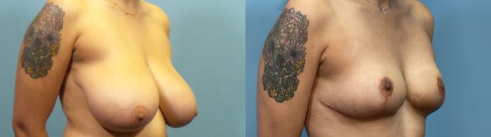 Before & After Breast Reduction Case 319 Right Oblique View in Portland, OR
