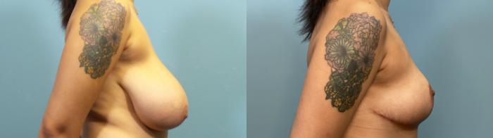 Before & After Breast Reduction Case 319 Right Side View in Portland, OR