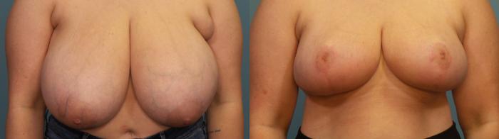 Before & After Breast Reduction Case 320 Front View in Portland, OR