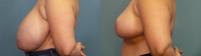 Before & After Breast Reduction Case 320 Left Side View in Portland, OR