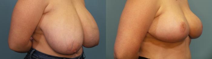 Before & After Breast Reduction Case 320 Right Oblique View in Portland, OR