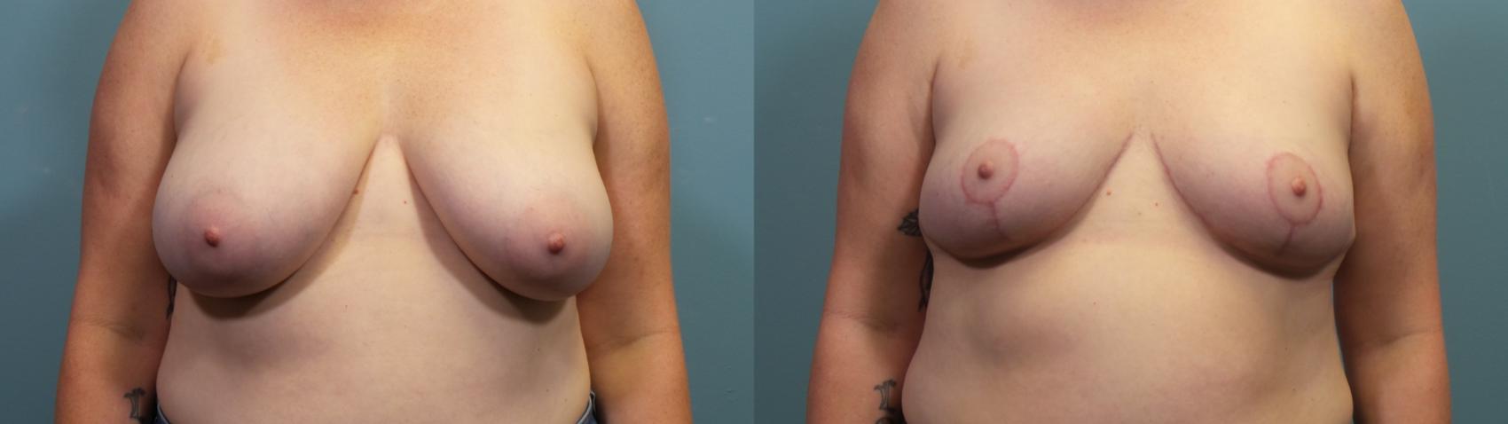 Before & After Breast Reduction Case 321 Front View in Portland, OR