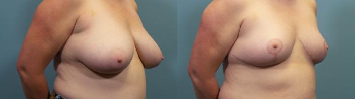 Before & After Breast Reduction Case 321 Right Oblique View in Portland, OR