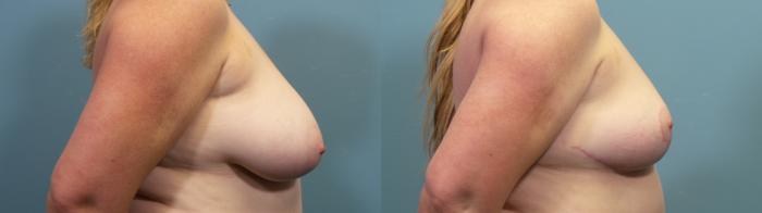 Before & After Breast Reduction Case 321 Right Side View in Portland, OR