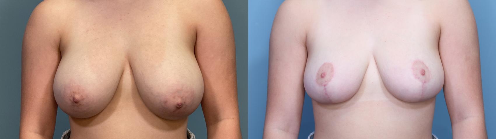 Before & After Breast Reduction Case 329 Front View in Portland, OR