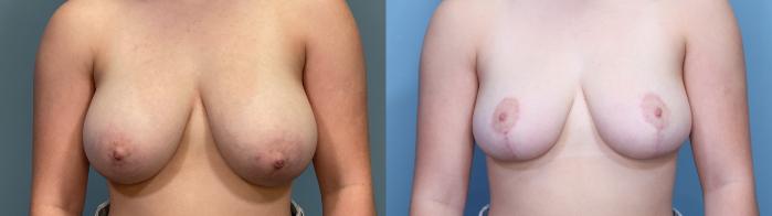 Before & After Breast Reduction Case 329 Front View in Portland, OR