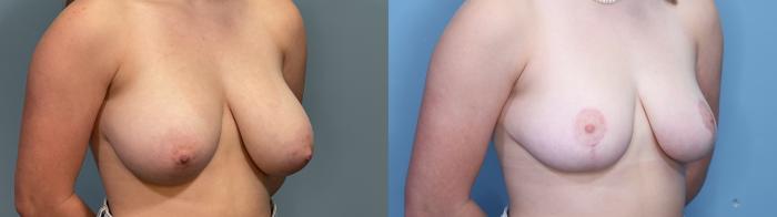 Before & After Breast Reduction Case 329 Right Oblique View in Portland, OR