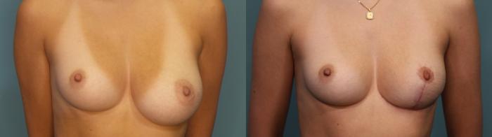 Before & After Breast Reduction Case 346 Front View in Portland, OR