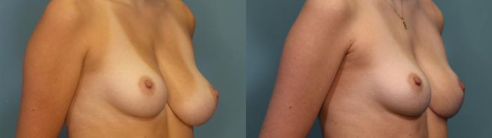 Before & After Breast Reduction Case 346 Right Oblique View in Portland, OR