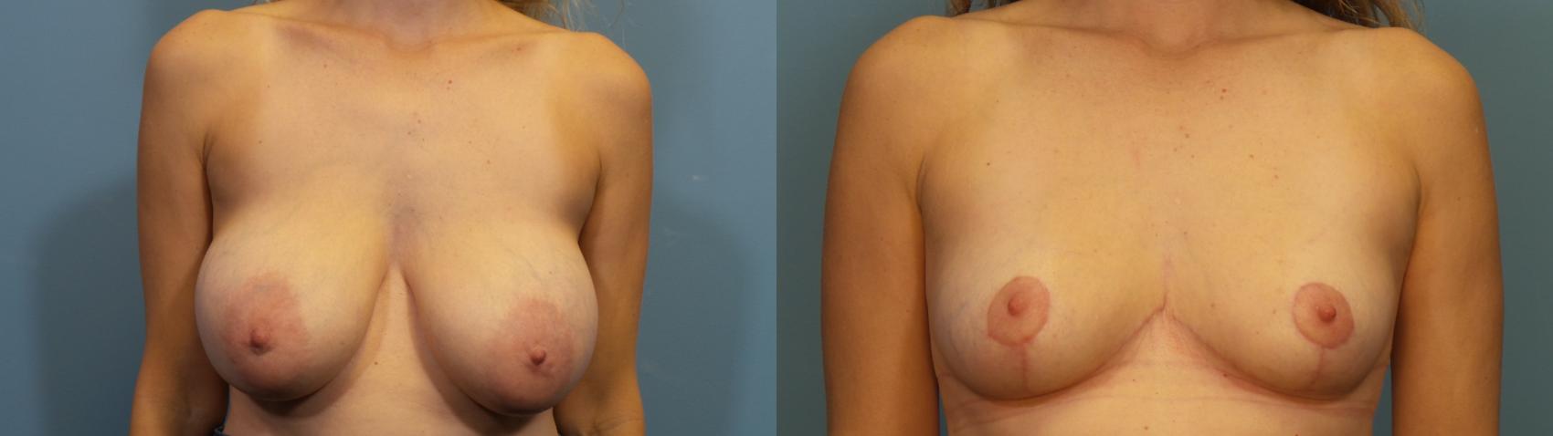 Before & After Breast Reduction Case 349 Front View in Portland, OR