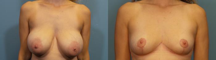 Before & After Breast Reduction Case 349 Front View in Portland, OR