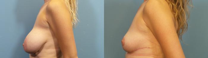 Before & After Breast Reduction Case 349 Left Side View in Portland, OR
