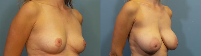 Before & After Breast Reduction Case 349 Right Oblique View in Portland, OR