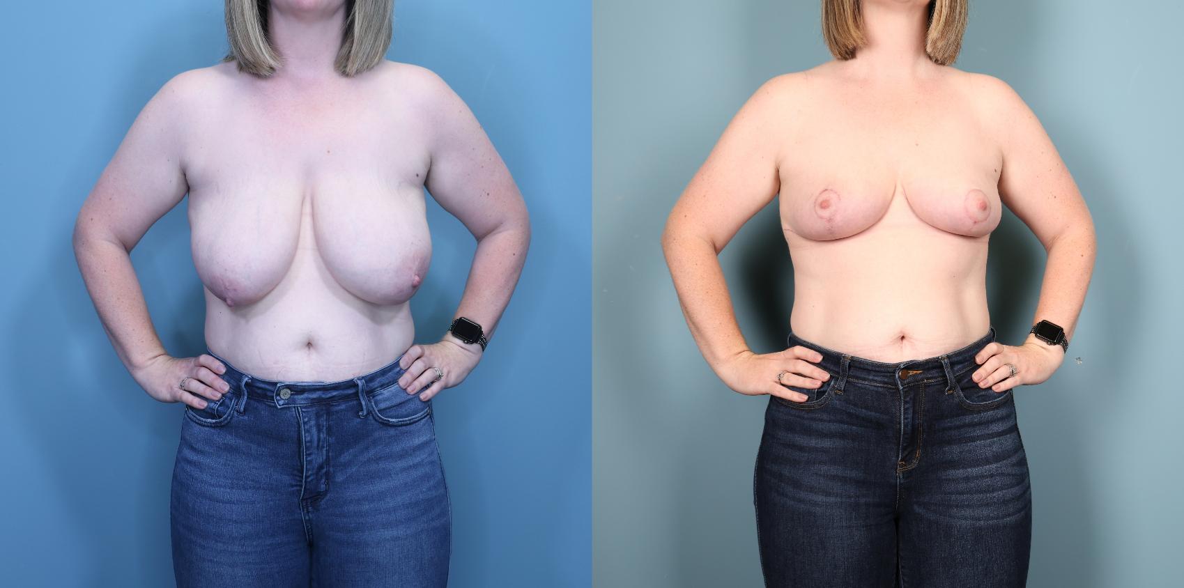 Before & After Breast Reduction Case 360 Front View in Portland, OR