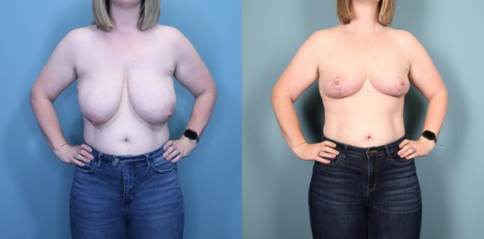 Before & After Breast Lift Case 360 Front View in Portland, OR