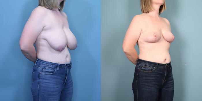 Before & After Breast Reduction Case 360 Right Oblique View in Portland, OR