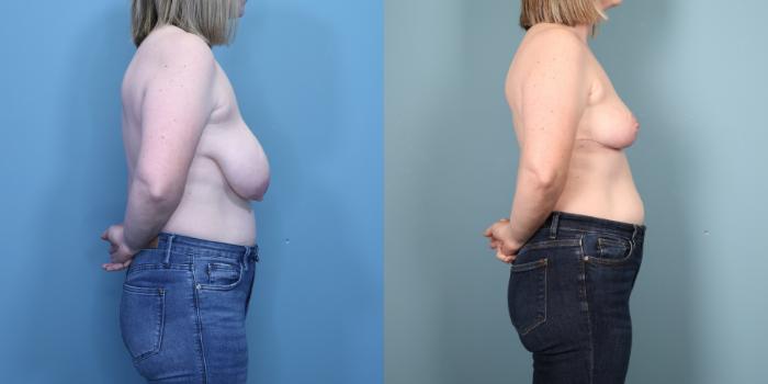 Before & After Breast Lift Case 360 Right Side View in Portland, OR