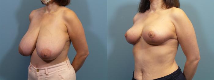 Before & After Breast Reduction Case 369 Left Oblique View in Portland, OR