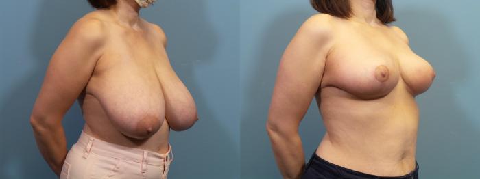 Before & After Breast Reduction Case 369 Right Oblique View in Portland, OR