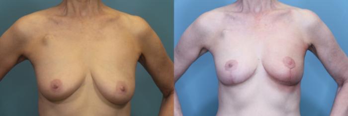 Before & After Breast Reduction Case 373 Front View in Portland, OR