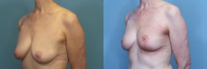 Before & After Breast Reduction Case 373 Left Oblique View in Portland, OR