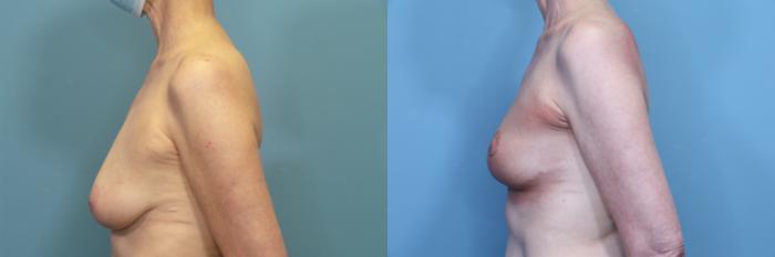 Before & After Breast Lift Case 373 Left Side View in Portland, OR