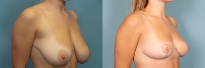 Before & After Breast Reduction Case 376 Left Oblique View in Portland, OR