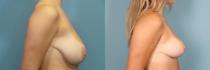 Before & After Breast Reduction Case 376 Left Side View in Portland, OR