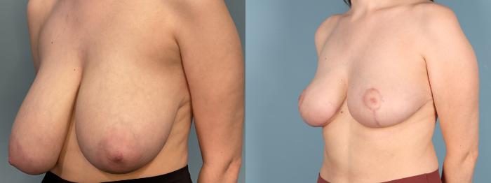 Before & After Breast Reduction Case 379 Left Oblique View in Portland, OR