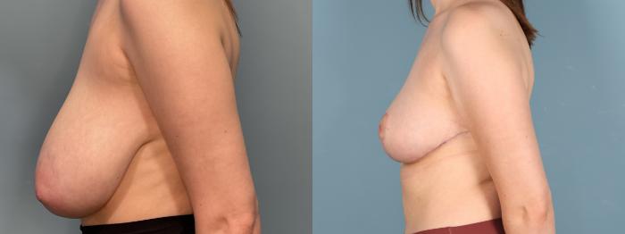 Before & After Breast Reduction Case 379 Left Side View in Portland, OR